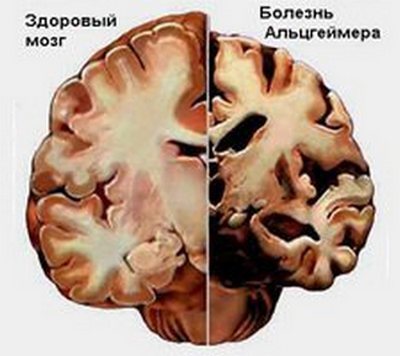 Особенности ухода за больными с синдромом Альцгеймера